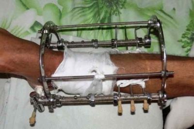 Fijadores externos, referente de ortopedia de Cuba en América Latina Fijadores externos, referente de ortopedia de Cuba en América Latina